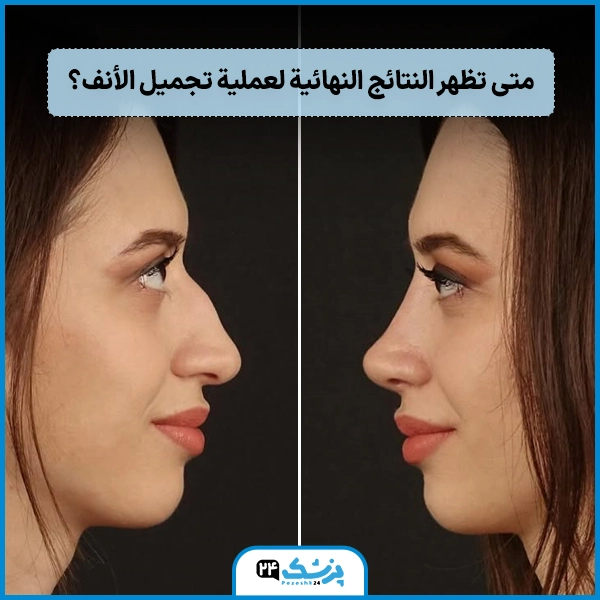 معلومات عن تجميل الانف