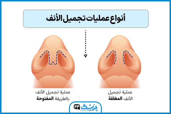 عملية الخشم