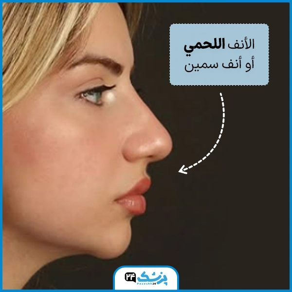 انواع الانوف