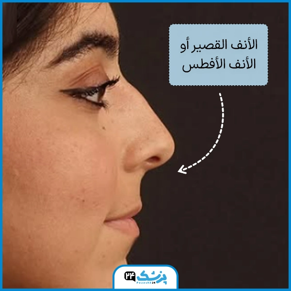 أشكال الأنف الأفطس