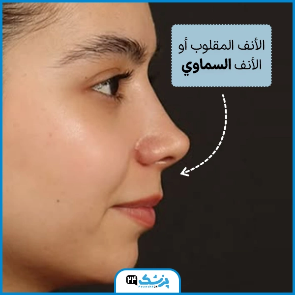 انواع الانف الكبير