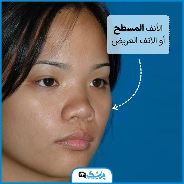 الأنف المسطح أو الأنف العريض