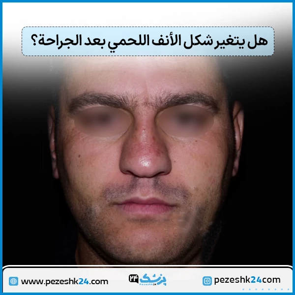 ماهو الانف اللحمي