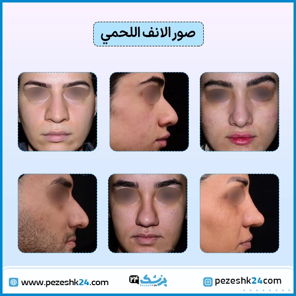 صور الانف اللحمي