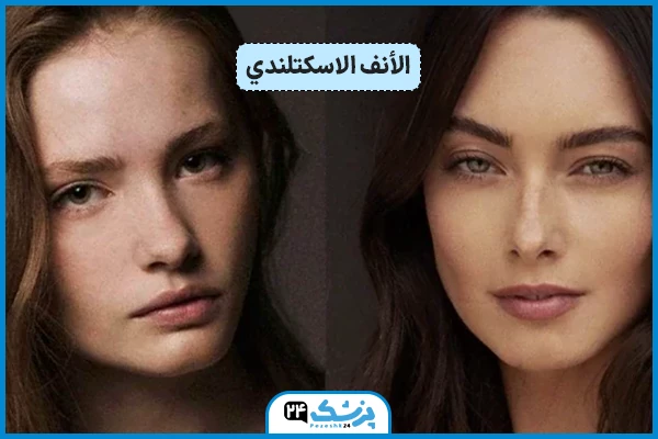 شكل الأنف الاسكتلندي