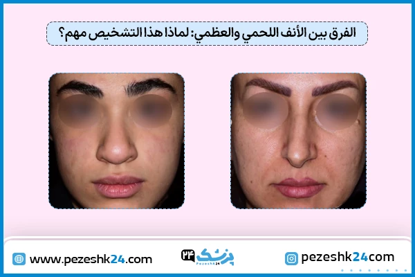 شكل الأنف اللحمي