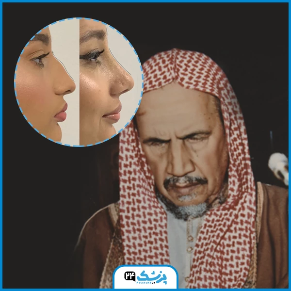 حكم عملية تجميل الانف