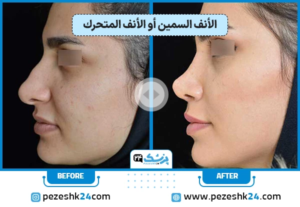 انواع الانف الكبير