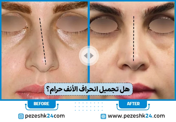 هل عملية انحراف الأنف حرام