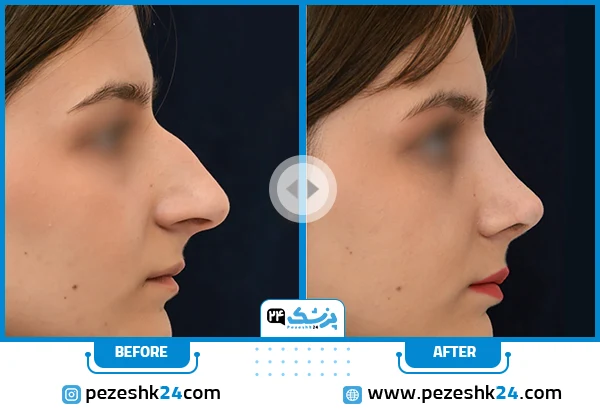 أجمل عمليات تجميل الأنف قبل وبعد (مثال رقم 1)