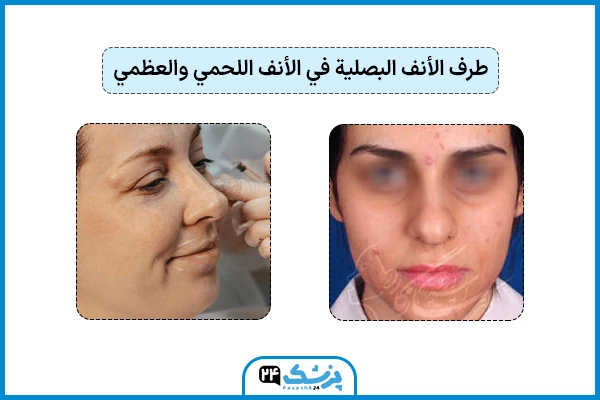 الفرق بين الخشم اللحمي والعظمي