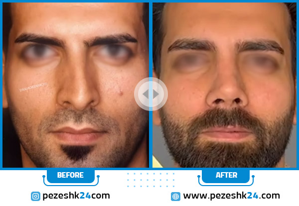 أجمل عمليات تجميل الأنف قبل وبعد (مثال رقم 10)