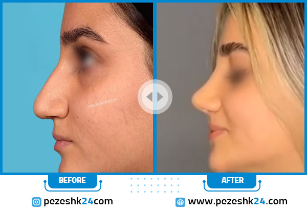 أجمل عمليات تجميل الأنف قبل وبعد (مثال رقم 11)