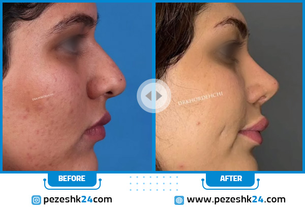 أجمل عمليات تجميل الأنف قبل وبعد (مثال رقم 12)