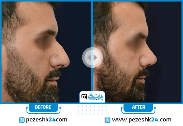 أجمل عمليات تجميل الأنف قبل وبعد (مثال رقم 2)