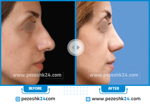 أجمل عمليات تجميل الأنف قبل وبعد (مثال رقم 5)