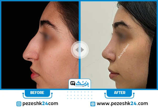 أجمل عمليات تجميل الأنف قبل وبعد (مثال رقم 6)