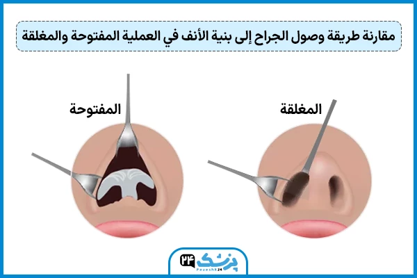 ما الفرق بين عملية تجميل الانف المغلقة والمفتوحة