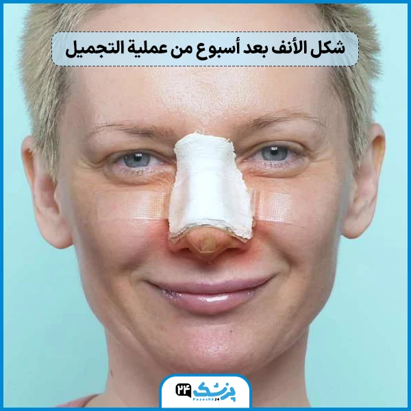 عملية تجميل الانف بعد اسبوع