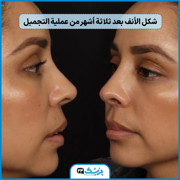تغير شكل الانف بعد عملية التجميل
