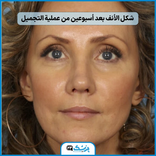 شكل الانف بعد عملية التجميل