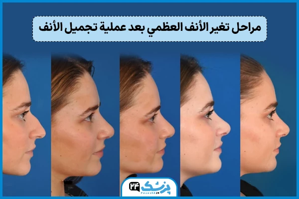 الانف بعد عملية التجميل