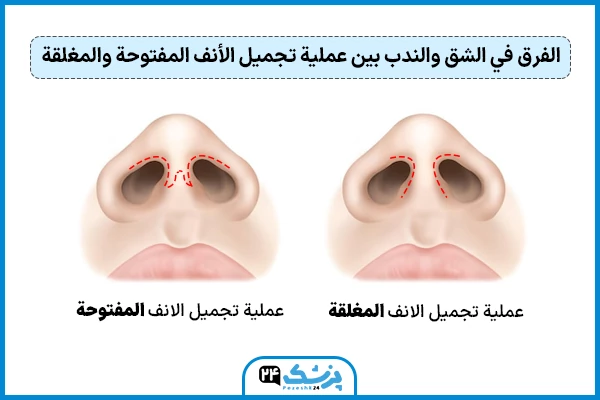 الفرق بين عملية الانف المفتوحه والمغلقه