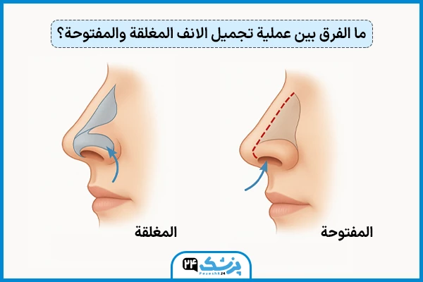 الفرق بين عملية الانف المغلقة والمفتوحة