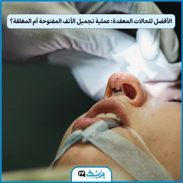 الأفضل للحالات المعقدة: عملية تجميل الأنف المفتوحة أم المغلقة؟