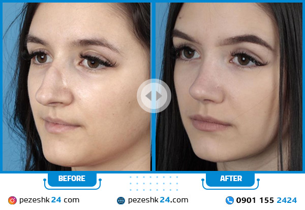 قبل و بعد نمونه عمل بینی با شکستگی استخوان