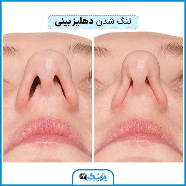 تنگ شدن دهلیز بینی