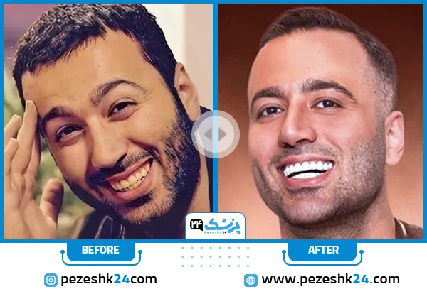 علی صبوری قبل و بعد از عمل بینی
