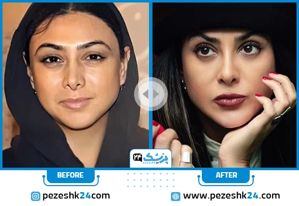 آزاده صمدی قبل از عمل بینی