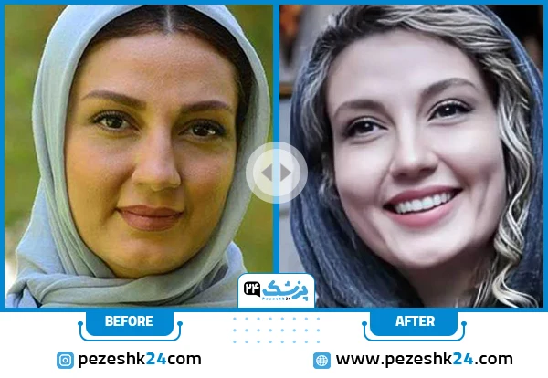 حدیث میرامینی قبل و بعد از عمل بینی