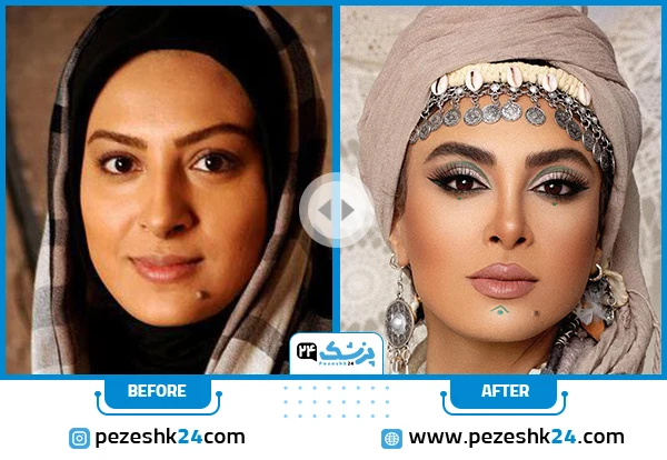 حدیثه تهرانی قبل و بعد از عمل بینی