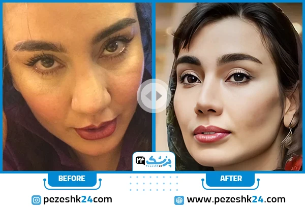 خاطره حاتمی قبل از بعد از عمل بینی