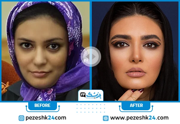 لیندا کیانی قبل و بعد از عمل بینی