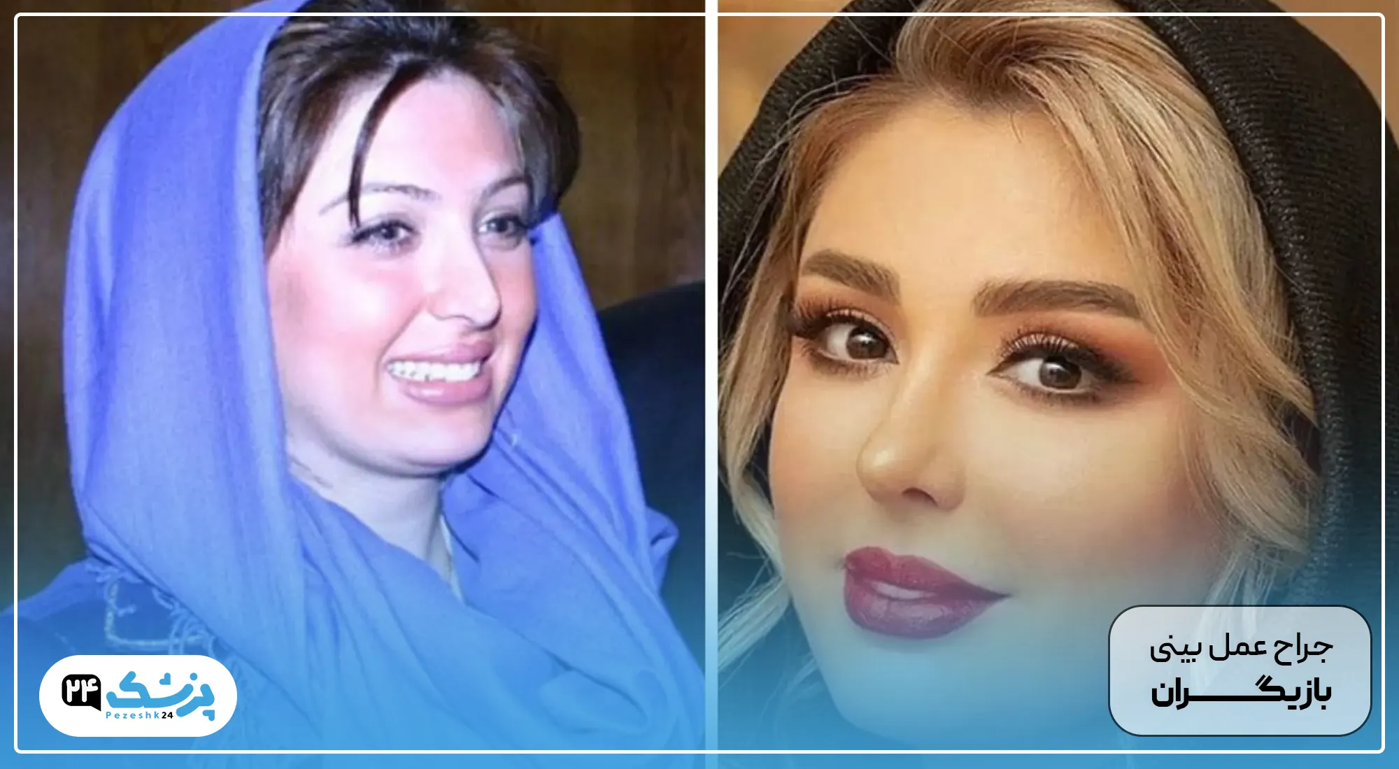 جراح بینی بازیگران