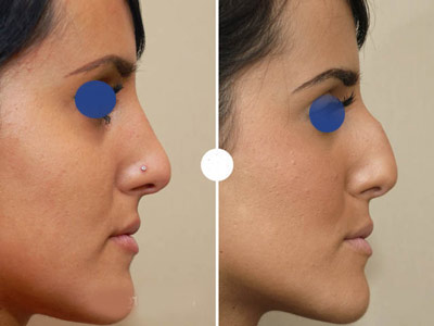 نمونه کار جراحی بینی دکتر حسن زاد آذر2 نمونه کار جراحی بینی دکتر حسن زاد آذر2