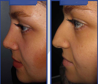 نمونه کار جراحی بینی دکتر طاهری4 نمونه کار جراحی بینی دکتر طاهری4