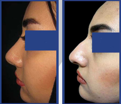 نمونه کار جراحی بینی دکتر طاهری1 نمونه کار جراحی بینی دکتر طاهری1