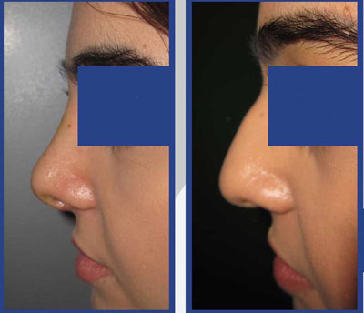 نمونه کار جراحی بینی دکتر طاهری2 نمونه کار جراحی بینی دکتر طاهری2