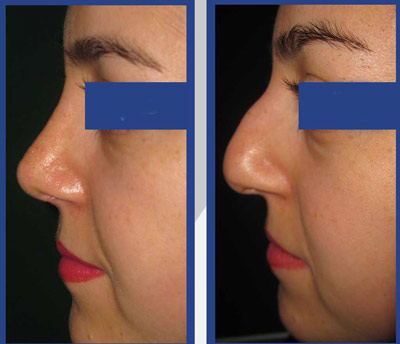 نمونه کار جراحی بینی دکتر طاهری3 نمونه کار جراحی بینی دکتر طاهری3