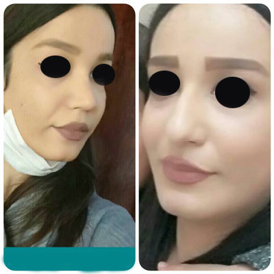 نمونه کار جراحی بینی دکتر حسن طاهری1 نمونه کار جراحی بینی دکتر حسن طاهری1