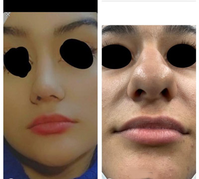 نمونه کار جراحی بینی دکتر شیرزاده1 نمونه کار جراحی بینی دکتر شیرزاده1