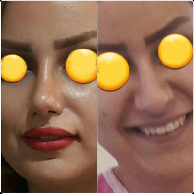 نمونه کار جراحی بینی دکتر شیرزاده2 نمونه کار جراحی بینی دکتر شیرزاده2