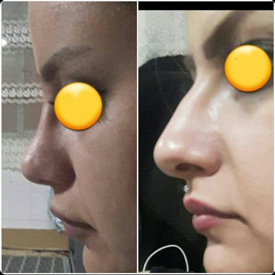 نمونه کار جراحی بینی دکتر شیرزاده3 نمونه کار جراحی بینی دکتر شیرزاده3