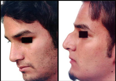 نمونه کار جراحی بینی دکتر رسولی3 نمونه کار جراحی بینی دکتر رسولی3