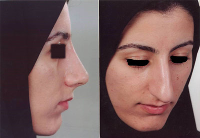 نمونه کار جراحی بینی دکتر رسولی2 نمونه کار جراحی بینی دکتر رسولی2