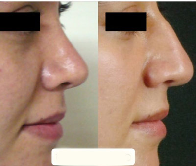 نمونه کار جراحی بینی دکتر حسن طاهری2 نمونه کار جراحی بینی دکتر حسن طاهری2